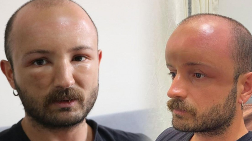 2 gün üst üste plaja gitti; aynaya bakınca şoke oldu