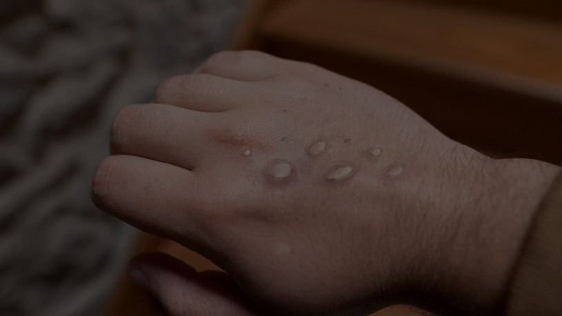 Türkiye'de maymun çiçeğine yakalananların sayısı 11'e yükseldi 