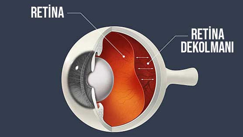 Retina Dekolmanı Tedavisi