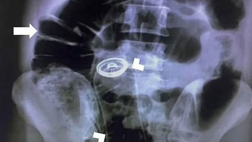 Tıp literatürüne girecek bir olay yaşandı: Röntgende kalçasından deodorant kutusu çıktı
