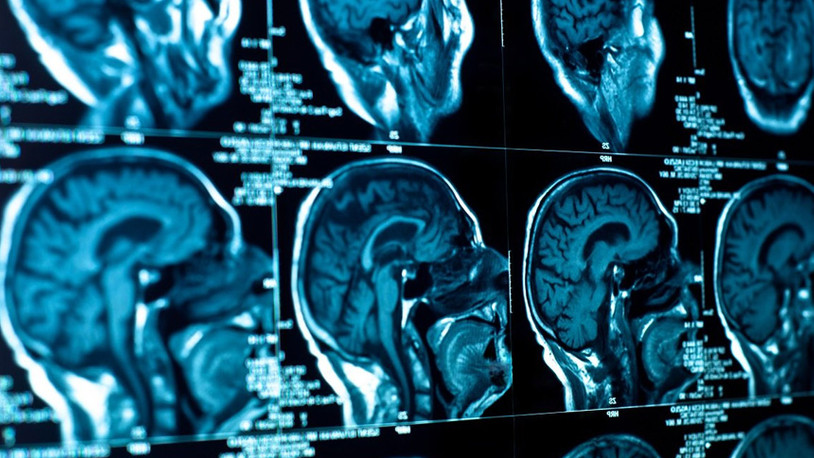 Yapay zeka sistemi ile beyin tümörü tespit edildi: Hastanın hayatı kurtuldu