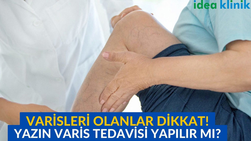 Yaz Aylarında Varis Tedavisi Yapılır Mı?